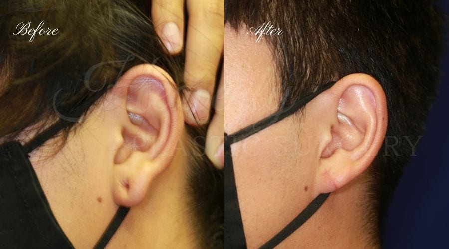 Buccal Fat Pad Removal, Buccal Fat Pad Removal Surgery, Cheekbone surgery, Cheek Plastic Surgery, Cheekbone Plastic Surgery, Cheek Surgery, Cheek Plastic Surgery, Contour Buccal Fat Pad Removal, Buccal Fat Pad Removal Surgery, Cheekbone surgery, Cheek Plastic Surgery, Cheekbone Plastic Surgery, Cheek Surgery, Cheek Plastic Surgery, Contour