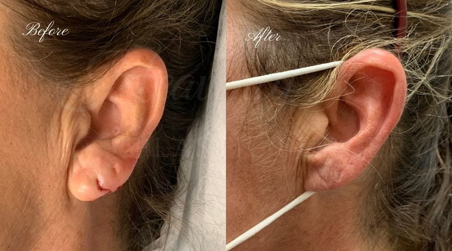 Plastic surgery, plastic surgeon, earlobe repair, before and after, earlobe surgery, closed earlobe surgery, close earlobe, surgery to close earlobe, torn earlobe, torn earlobe surgery