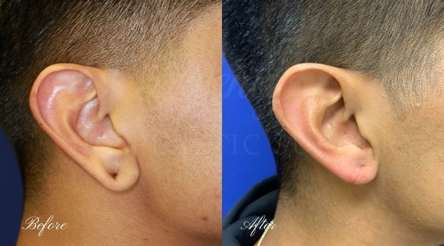 Plastic surgery, plastic surgeon, earlobe repair, before and after, earlobe surgery, closed earlobe surgery, close earlobe, surgery to close earlobe