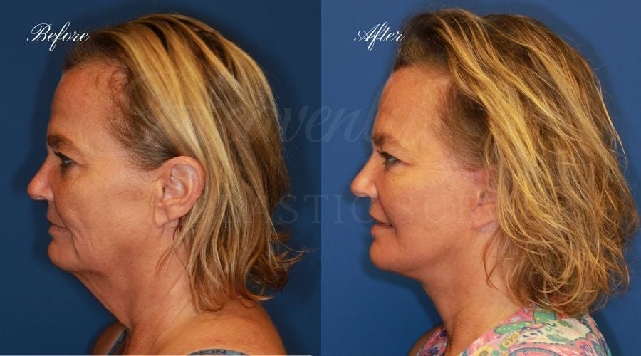face lift, cosmetic surgery, neck lift, plastic surgery, before and after face lift, face surgery, plastic surgery