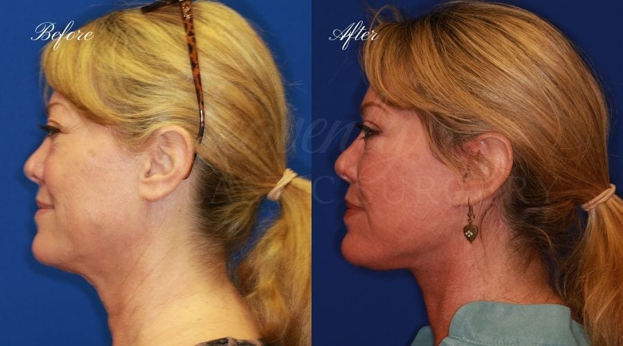 face lift, cosmetic surgery, neck lift, plastic surgery, before and after face lift, face surgery, plastic surgery