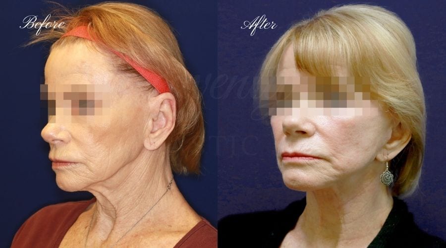 face lift, cosmetic surgery, neck lift, plastic surgery, before and after face lift, face surgery, plastic surgery, facelift, necklift, c02 laser, laser treatment, laser treatment before and after, laser skincare,