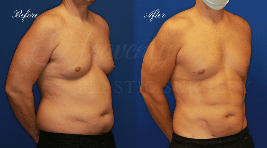 Plastic surgery, plastic surgeon, gynecomastia excision, man boobs, lipoetching, abs, gynecomastia excision