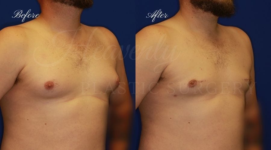 Plastic surgery, plastic surgeon, gynecomastia excision, man boobs