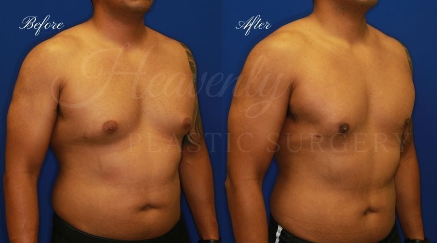 Heavenly Plastic Surgery, plastic Surgery, PLastic Surgeon, Gynecomastia, Man Boobs, male breasts, breast surgery, man boob sugery