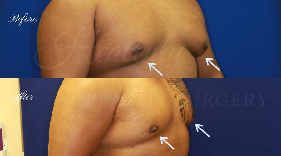 Plastic surgery, plastic surgeon, gynecomastia excision, man boobs