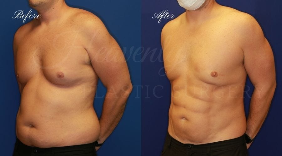 Gynecomastia, Man Boobs, Man boobs surgery, Gynecomastia surgery, male breast tissue, liposuction, lipoetching, lipo-etching, gynecomastia before and after, liposuction before and after, lipoetching before and after, plastic surgery before and after, gynecomastia orange county, gynecomastia near me, liposuction orange county, liposuction near me, lipoetching orange county