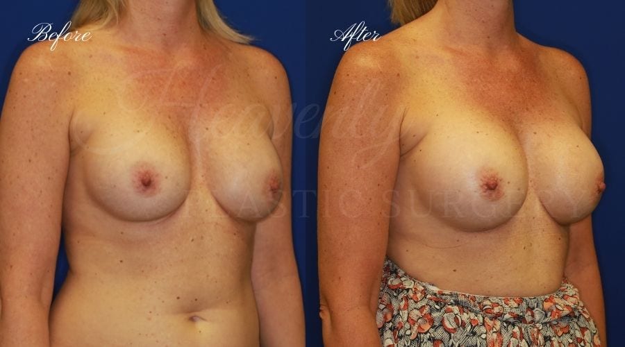 Plastic surgery, plastic surgeon, breast surgery, breast implant revision, deflated breast implant, breast augmentation correction, implant exchange, breast implants, implant exchange, breast implant exchange Plastic surgery, plastic surgeon, breast surgery, breast implant revision, deflated breast implant, breast augmentation correction, implant exchange, breast implants, implant exchange, breast implant exchange