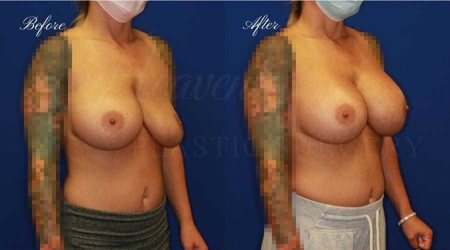 Plastic surgery, plastic surgeon, breast surgery, breast implant revision, deflated breast implant, breast augmentation correction