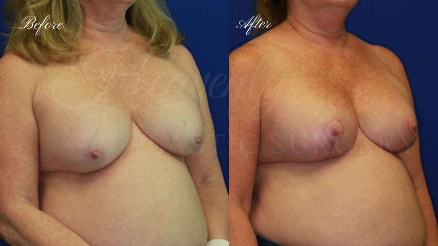 Breast Implant Exchange and Breast Lift - 310cc SRM Silicone Implants with Wise pattern Mastopexy (Anchor Scar)