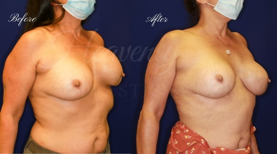 Plastic surgery, plastic surgeon, breast surgery, breast implant revision, deflated breast implant, breast augmentation correction, Capsulectomy, Capsular Contracture Plastic surgery, plastic surgeon, breast surgery, breast implant revision, deflated breast implant, breast augmentation correction, Capsulectomy, Capsular Contracture