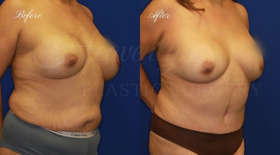 Plastic Surgery, Plastic Surgeon, Mommy Makeover, Tummy Tuck, Breast Implant Exchange, Implant Remove and Replace, Breast Implants, Breast Surgery, Plastic Surgery Orange County, Orange County Plastic Surgeon