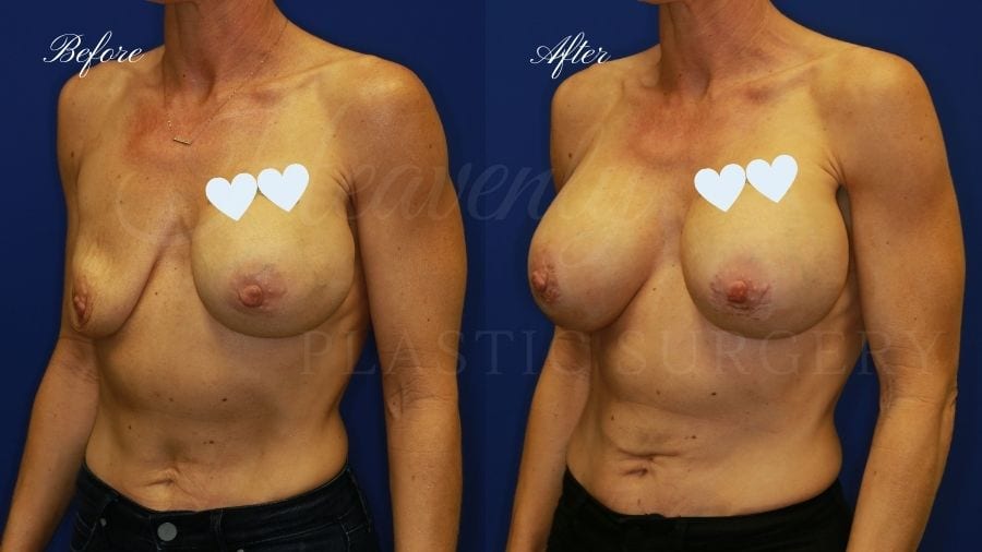 Plastic surgery, plastic surgeon, breast surgery, breast implant revision, deflated breast implant, breast augmentation correction