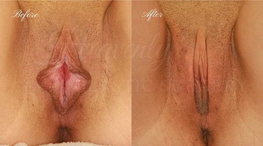 Labiaplasty, vaginal surgery, vaginal rejuvenation, vaginal reconstruction, vaginal rejuvination, labiaplasty orange county, labiaplasty surgery, labia minora, labia majora