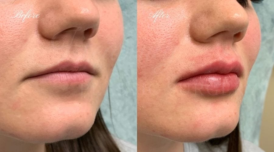 Lip filler, lip injection, juvederm, volbella, bigger lips, more lip volume, Versa, Revanesse Versa Lip filler, lip injection, juvederm, volbella, bigger lips, more lip volume, Versa, Revanesse Versa