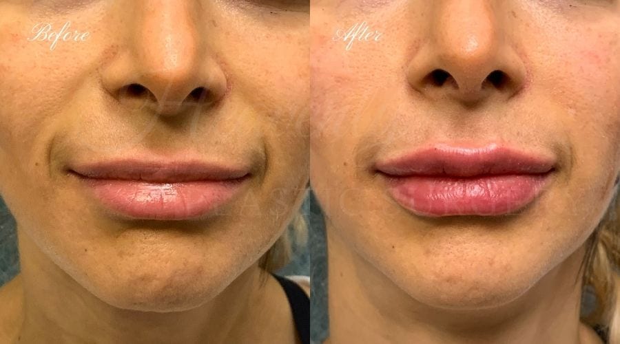 Lip filler, lip injection, juvederm, volbella, bigger lips, more lip volume Lip filler, lip injection, juvederm, volbella, bigger lips, more lip volume
