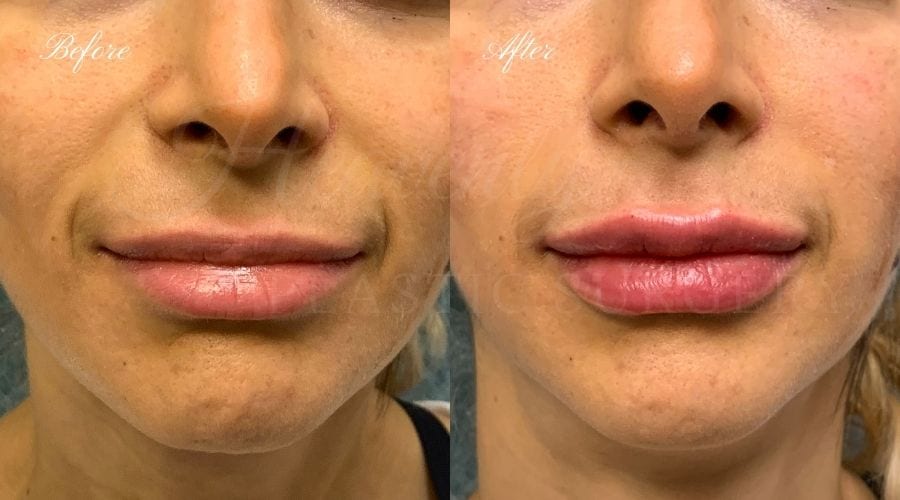 Lip filler, lip injection, juvederm, volbella, bigger lips, more lip volume