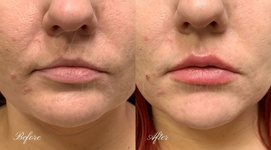 Lip filler, lip injection, juvederm, volbella, bigger lips, more lip volume