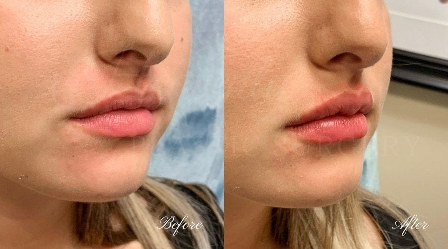 Lip filler, lip injection, juvederm, volbella, bigger lips, more lip volume, Versa, Revanesse Versa Lip filler, lip injection, juvederm, volbella, bigger lips, more lip volume, Versa, Revanesse Versa
