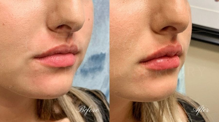 Lip filler, lip injection, juvederm, volbella, bigger lips, more lip volume, Versa, Revanesse Versa