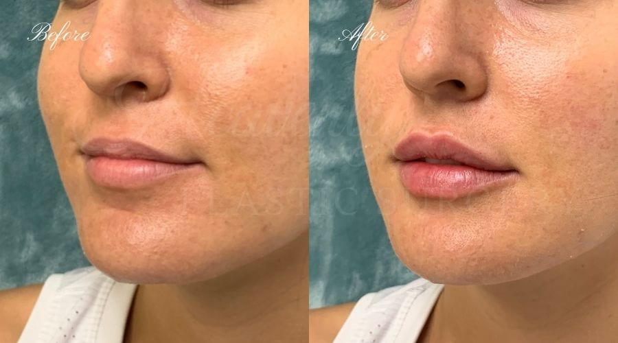 Plastic Surgery, Plastic Surgeon, Heavenly Plastic Surgery, Lip Fillers, Fillers, Versa, Revanesse Versa, Lip Filler results, lip filler orange county