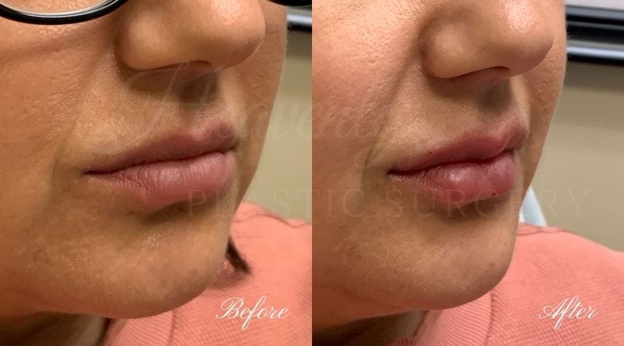 Lip filler, lip injection, juvederm, volbella, bigger lips, more lip volume