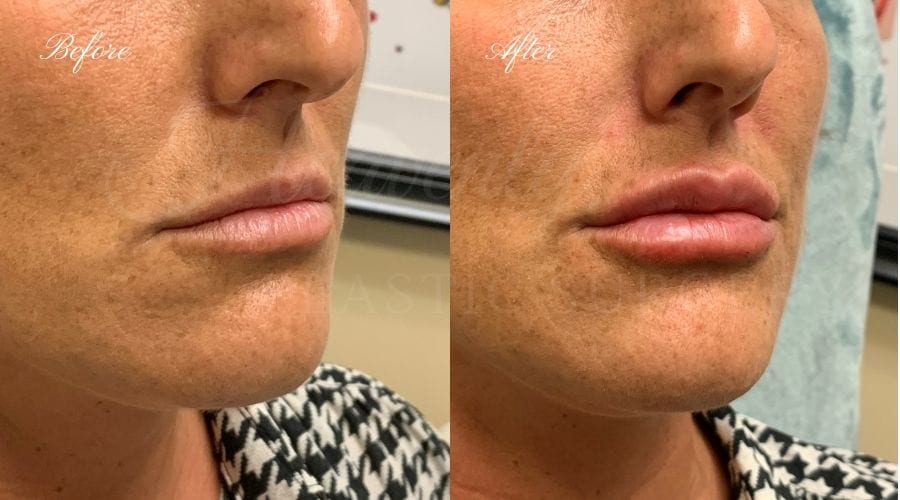 Lip filler, lip injection, juvederm, volbella, bigger lips, more lip volume Lip filler, lip injection, juvederm, volbella, bigger lips, more lip volume