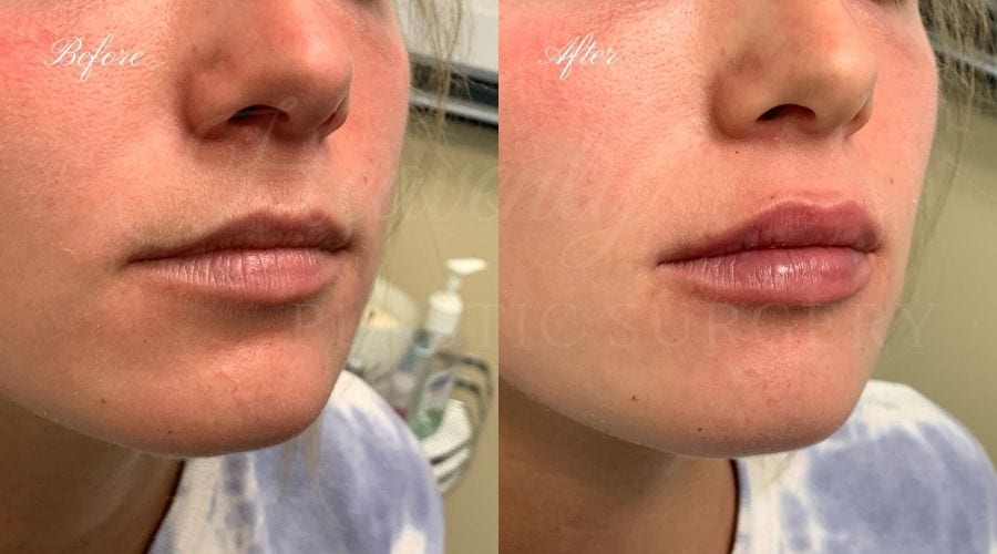 Plastic Surgery, Plastic Surgeon, Medical Spa, Lip Fillers, Versa, Revanesse Versa, hyaluronic acid Plastic Surgery, Plastic Surgeon, Medical Spa, Lip Fillers, Versa, Revanesse Versa, hyaluronic acid