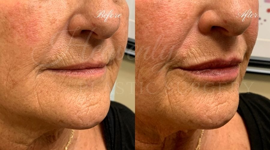 Plastic Surgery, Plastic Surgeon, Heavenly Plastic Surgery, Lip Fillers, Fillers, Versa, Revanesse Versa Plastic Surgery, Plastic Surgeon, Heavenly Plastic Surgery, Lip Fillers, Fillers, Versa, Revanesse Versa