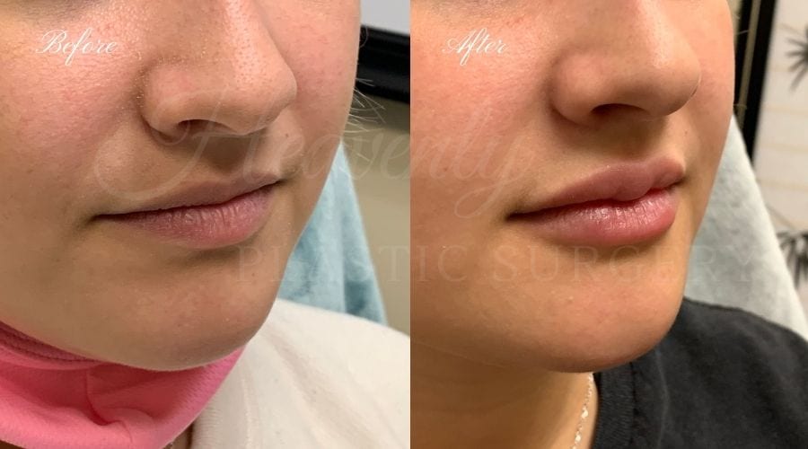 Plastic Surgery, Plastic Surgeon, Heavenly Plastic Surgery, Lip Fillers, Fillers, Versa, Revanesse Versa Plastic Surgery, Plastic Surgeon, Heavenly Plastic Surgery, Lip Fillers, Fillers, Versa, Revanesse Versa