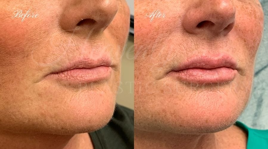 Plastic Surgery, Plastic Surgeon, Heavenly Plastic Surgery, Lip Fillers, Fillers, Versa, Revanesse Versa Plastic Surgery, Plastic Surgeon, Heavenly Plastic Surgery, Lip Fillers, Fillers, Versa, Revanesse Versa