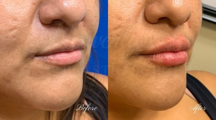 Lip filler, lip injection, juvederm, volbella, bigger lips, more lip volume, Versa, Revanesse Versa Lip filler, lip injection, juvederm, volbella, bigger lips, more lip volume, Versa, Revanesse Versa