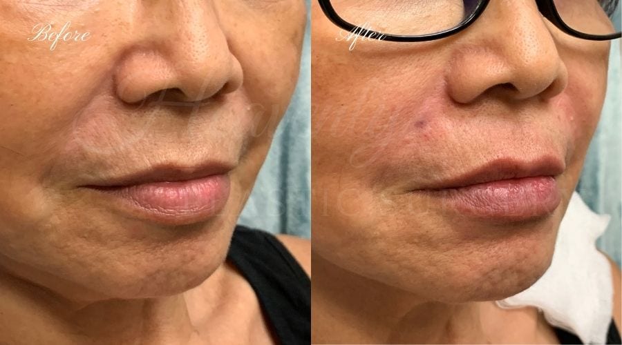 Plastic Surgery, Plastic Surgeon, Heavenly Plastic Surgery, Lip Fillers, Fillers, Versa, Revanesse Versa Plastic Surgery, Plastic Surgeon, Heavenly Plastic Surgery, Lip Fillers, Fillers, Versa, Revanesse Versa