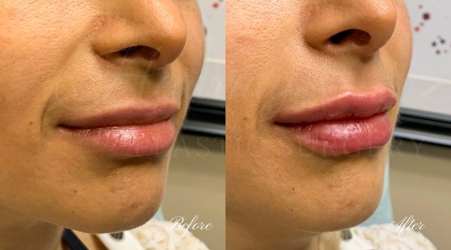 Lip filler, lip injection, juvederm, volbella, bigger lips, more lip volume Lip filler, lip injection, juvederm, volbella, bigger lips, more lip volume