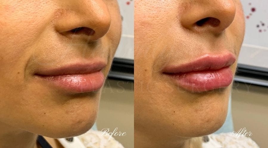 Lip filler, lip injection, juvederm, volbella, bigger lips, more lip volume