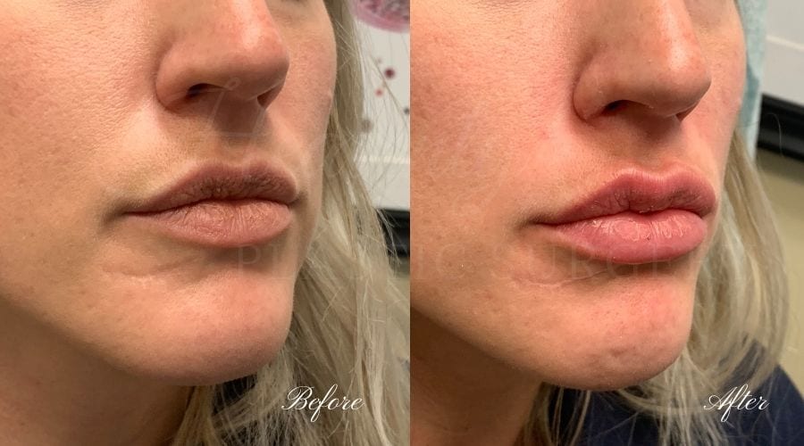 Lip filler, lip injection, juvederm, volbella, bigger lips, more lip volume, Versa, Revanesse Versa Lip filler, lip injection, juvederm, volbella, bigger lips, more lip volume, Versa, Revanesse Versa