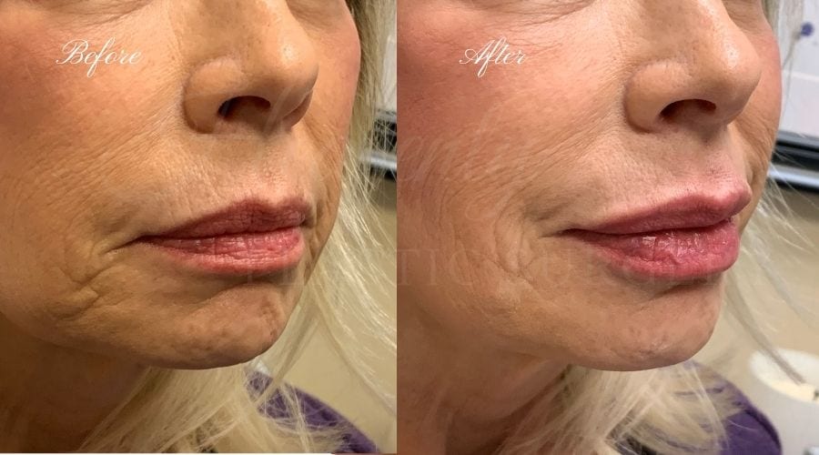 LIP FILLER GALLERY - Heavenly Plastic Surgery