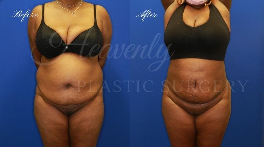 Heavenly Plastic Surgery, Plastic Surgery, Plastic Surgeon, Liposuction, Abdominal Liposuction, Lipo 360, Liposuction 360, BBL, Brazilian Butt Lift, Fat Transfer