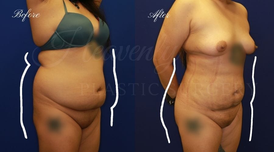 BBL, Brazilian Butt Lift, Brazilian Butt Lift Surgery, Butt Augmentation, Butt Augmentation Surgery, Liposuction, Lipo 360, Brazilian Butt LIft Before and After, Brazilian Butt Lift Results, Liposuction Results, Liposuction Before and After BBL, Brazilian Butt Lift, Brazilian Butt Lift Surgery, Butt Augmentation, Butt Augmentation Surgery, Liposuction, Lipo 360, Brazilian Butt LIft Before and After, Brazilian Butt Lift Results, Liposuction Results, Liposuction Before and After