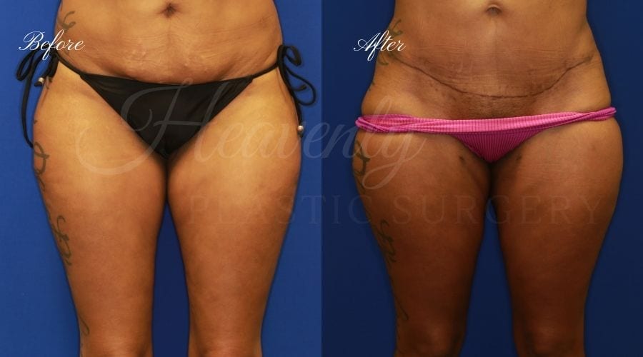 Plastic Surgery, Plastic Surgeon, Liposuction, liposuction before and after, thigh liposuction