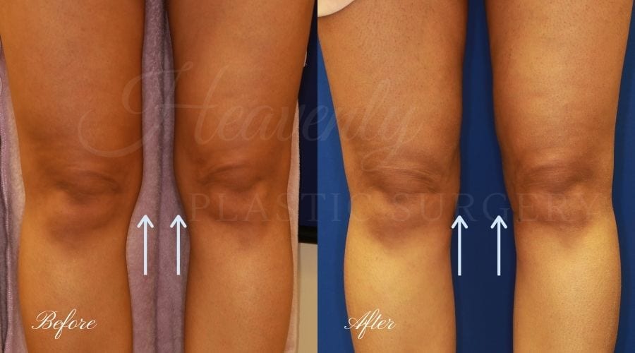 Plastic surgery, plastic surgeon, liposuction thighs Plastic surgery, plastic surgeon, liposuction thighs