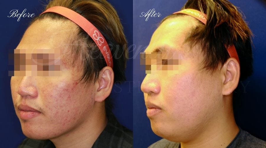 Microneedling, Microneedling results, microneedling before and after, microdermabrasion, hyperpigmentation, skin texture procedure, skincare, facial, skinpen