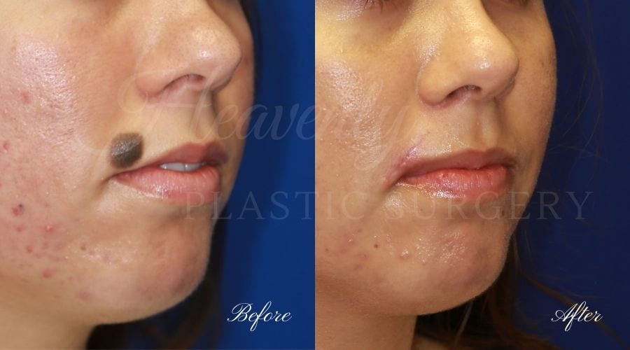 Plastic Surgery, Plastic Surgeon, Heavenly Plastic Surgery, Mole Excision, Mole Surgery, Mole Plastic Surgery, Plastic Surgeon, Heavenly Plastic Surgery, Mole Excision, Mole Surgery, Mole