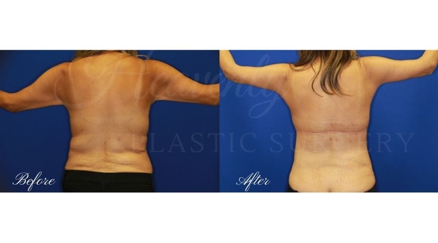 Plastic Surgery, plastic surgeon, arm lift, brachioplasty, back lift, upper body lift