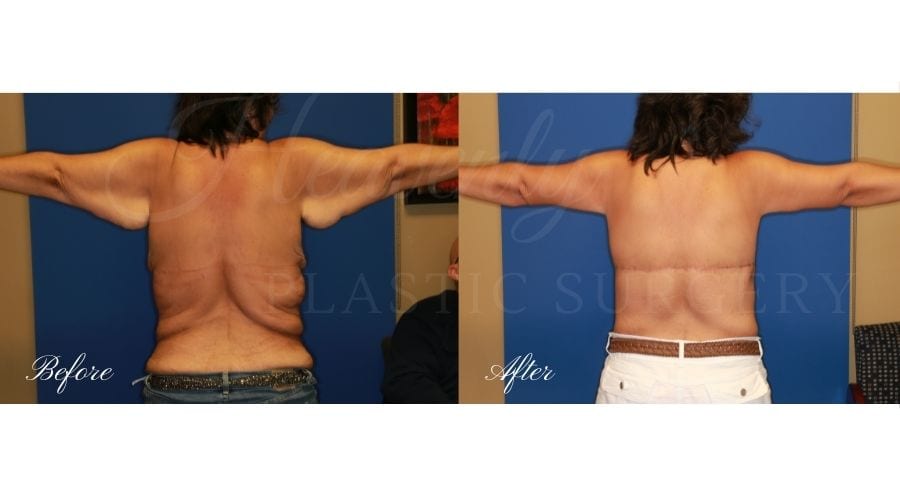 Mommy Makeover - Arm Lift, Body Lift, Breast Lift Before and After, Tummy Tuck, Abdominoplasty, Liposuction, before and after bodylift, plastic surgery, plastic surgeon, bodylift, upper body lift, breast lift
