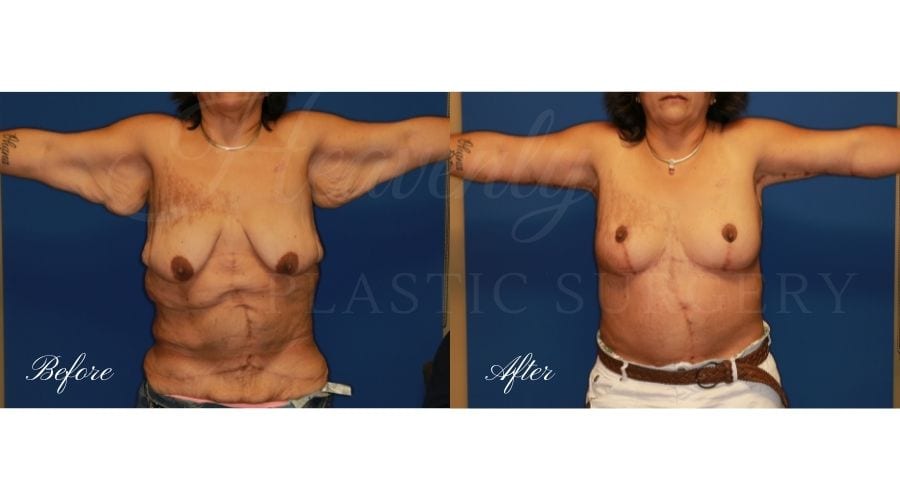 Tummy Tuck, Abdominoplasty, Liposuction, before and after bodylift, plastic surgery, plastic surgeon, bodylift, upper body lift, breast lift