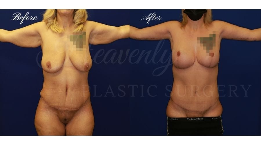 Mommy Makeover - Arm LIft + Breast Lift, Before and After, Plastic Surgery, Plastic Surgeon, Tummy Tuck, Arm Lift, Breast Lift, Liposuction