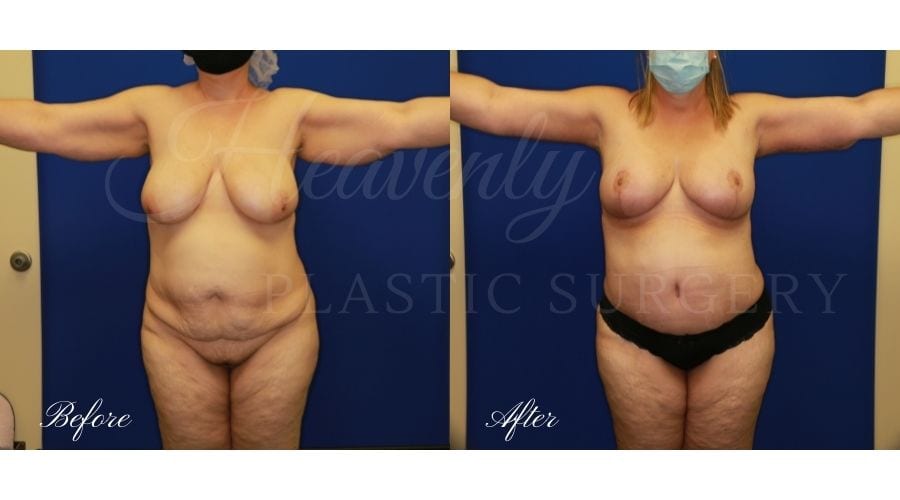 Mommy Makeover - Arm Lift + Breast Lift + Tummy Tuck, Plastic Surgery, Plastic Surgeon, Tummy Tuck, Arm Lilft, Breast Lift, Liposuction