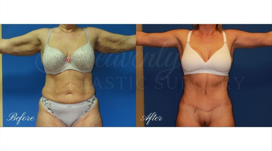 Mommy Makeover - Arm Lift + Tummy Tuck Before and After, Mommy Makeover Orange County, Mommy Makeover Surgeon, Mommy Makeover Journey, Plastic Surgery Before and After, Plastic Surgery Results, Mommy Makeover Results