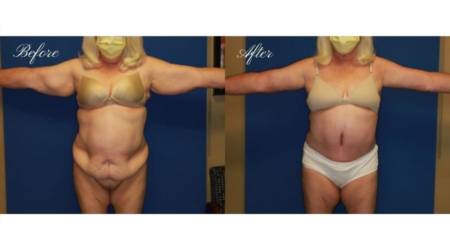 Mommy Makeover - Arm Lift + Tummy Tuck Before and After, Plastic Surgery, plastic surgeon, mommy makeover, arm lift, abdominoplasty, brachioplasty, extra skin